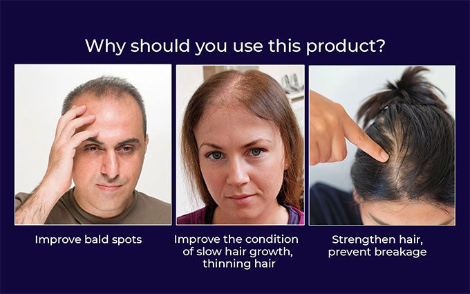 🌿LAST DAY PROMOTION - 70% OFF🌿 HZA™ Natural Hair Regrowth Spray