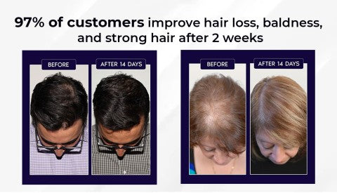 🌿LAST DAY PROMOTION - 70% OFF🌿 HZA™ Natural Hair Regrowth Spray