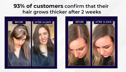 🌿LAST DAY PROMOTION - 70% OFF🌿 HZA™ Natural Hair Regrowth Spray